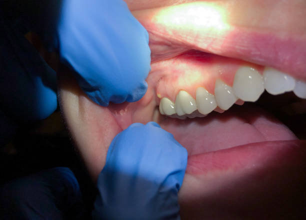 Best Broken or Chipped Tooth Repair in Bayou Vista, TX